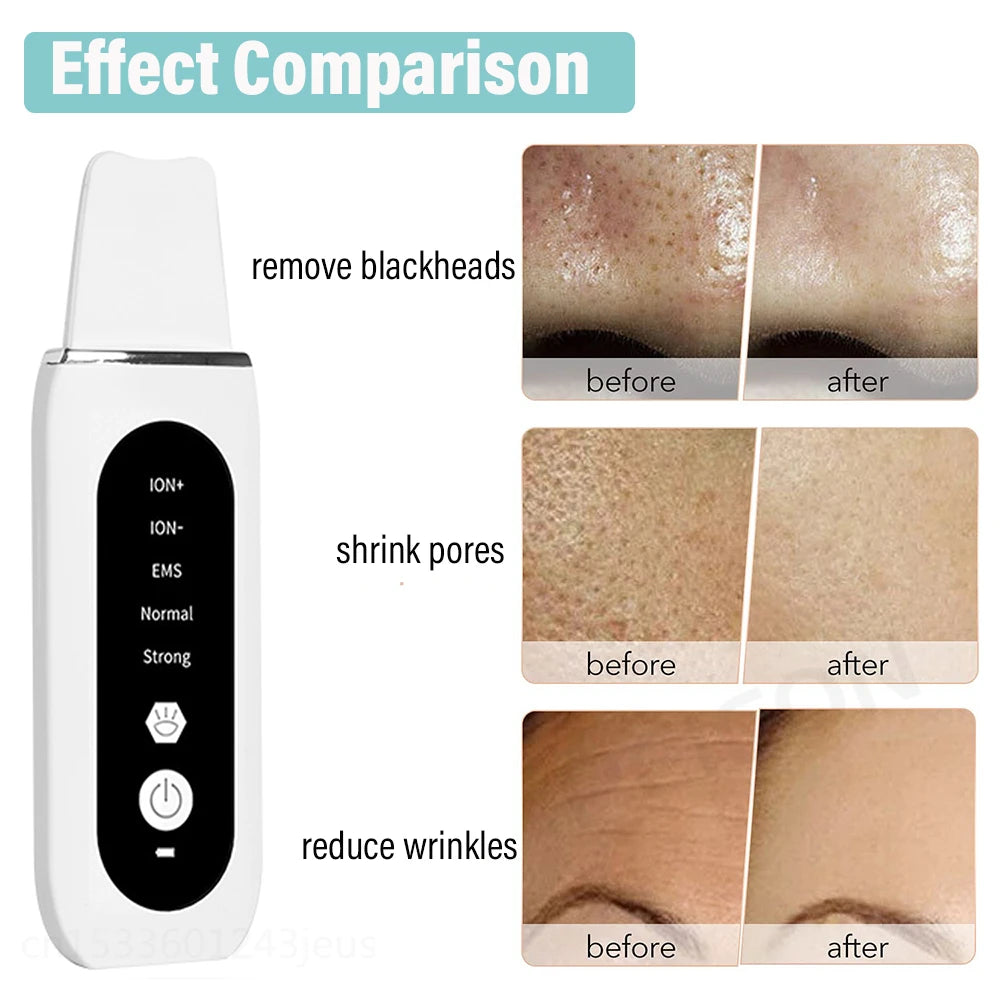 peicon Ultrasonic Skin Scrubber – Deep Face Cleaning, Blackhead Remover, EMS Ion Facial Spatula